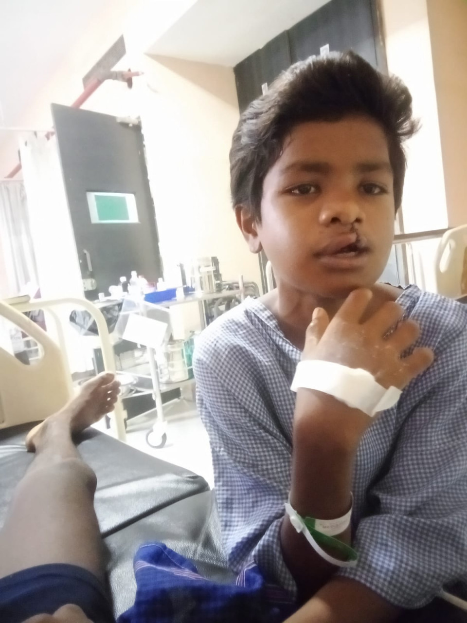 चिरायु दल ने लौटाई मुस्कान, जन्मजात कटे होंठ और तालु से मिली मुक्ति