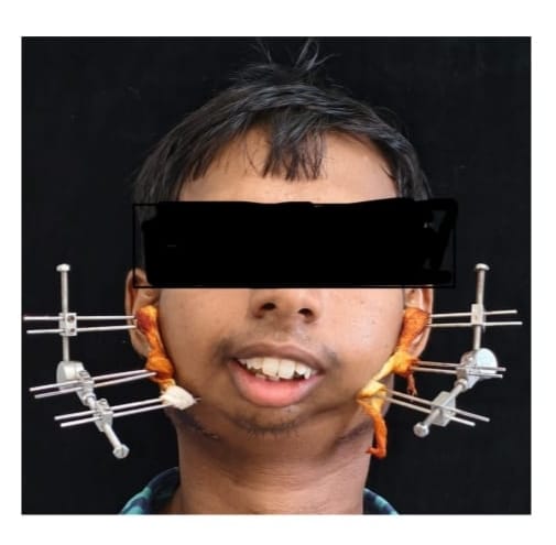जटिल सर्जरी से खुला मुंह, आयुष्मान योजना से मिला निःशुल्क उपचार जटिल सर्जरी से खुला मुंह, आयुष्मान योजना से मिला निःशुल्क उपचार
